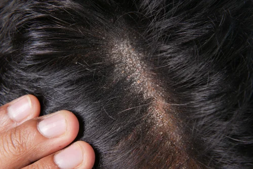 dandruff treatment